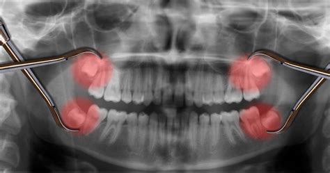 Wisdom Teeth x-ray | Meyer & Johns Dental Clinic