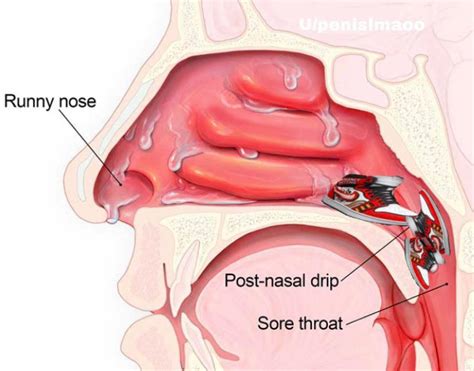 Nasal drip | Drip | Know Your Meme