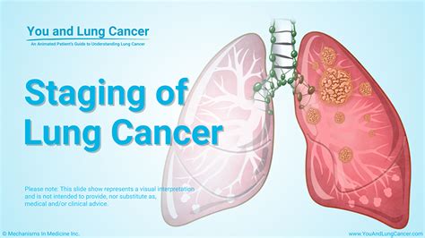 Slide Show - Diagnosis and Screening of Lung Cancer