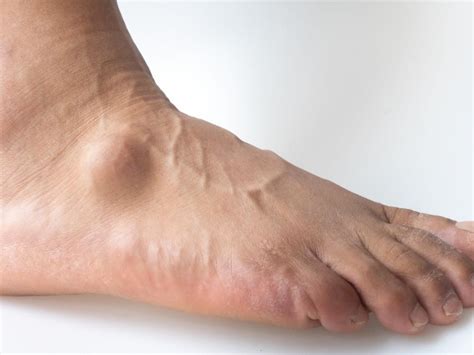 What Causes a Ganglion Cyst on Your Foot and Ankle?: Podiatry Hotline Foot & Ankle: Foot and ...