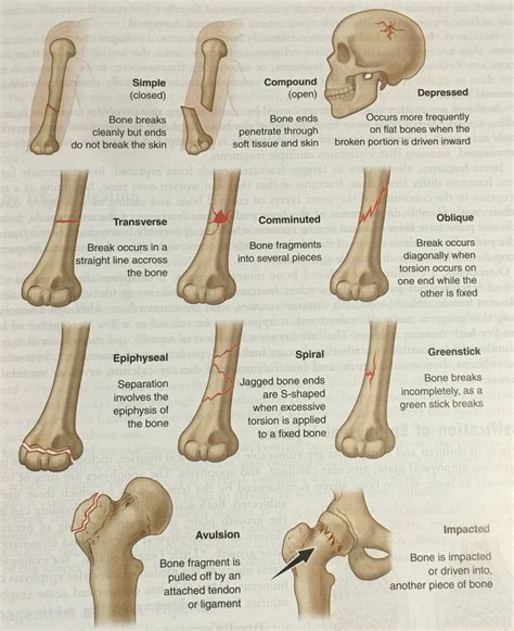 Twitter | Medical, Types of fractures, Pediatric nursing