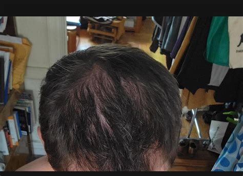 would a buzz cut make these bald spots less obvious? : r/Hairloss