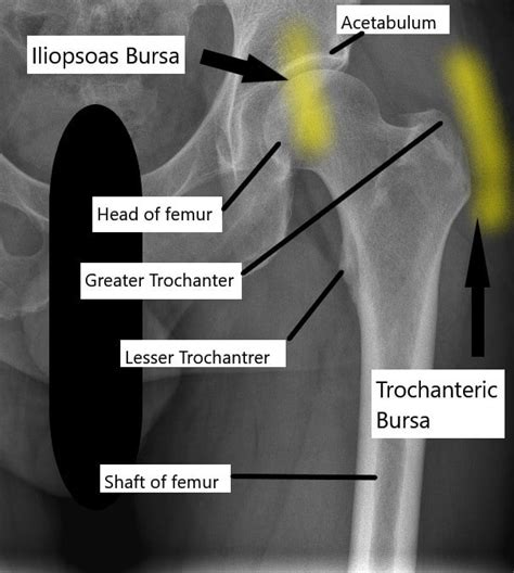 Iliopsoas Bursitis Injection