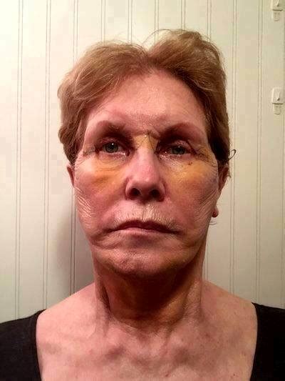 Lower Facelift Recovery After 5 Days » Facelift: Info, Prices, Photos, Reviews, Q&A