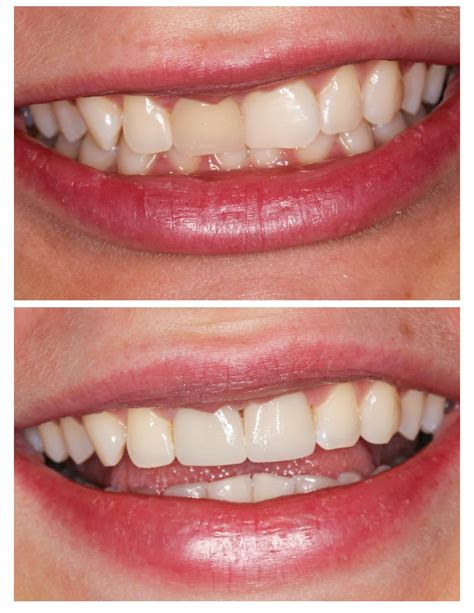 Teeth Veneers Before And After