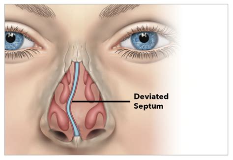 Deviated Septum Symptoms in Houston - Texas Sinus & Snoring