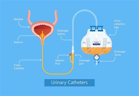 Proper Foley Catheter Care