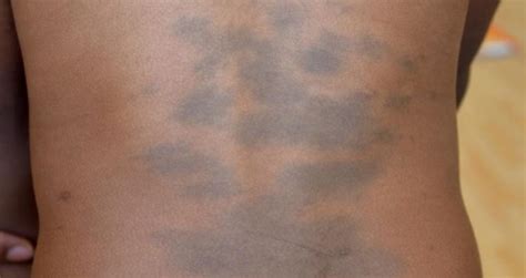 Mongolian Birthmark or Spot: Causes, Signs & Removal - Skincarederm