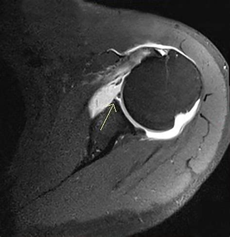 Gallery For > Rotator Cuff Tear Mri Without Contrast