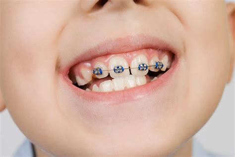 3 Benefits of Braces for Kids | Pediatric Orthodontics Houston Texas