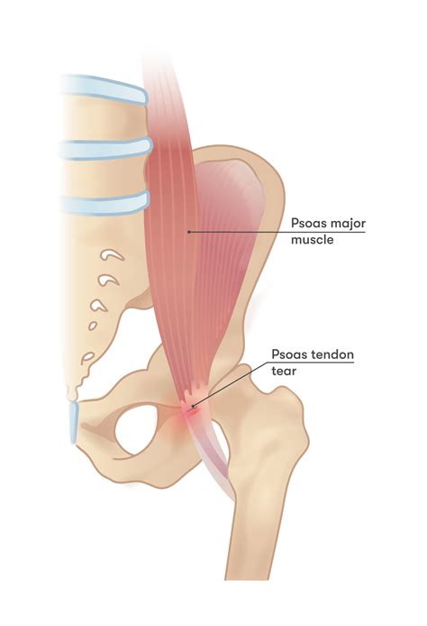 Hip Pain After Running: Causes, Pain Relief & Prevention