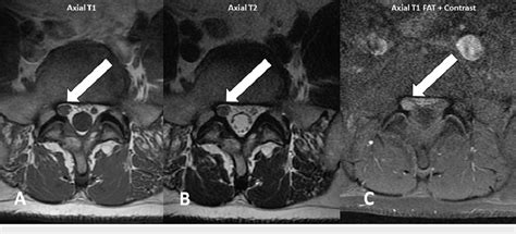 (A-C) MRI images of the lumbar spine demonstrate neuritis of the right... | Download Scientific ...