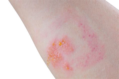 Poison Ivy Rash: How To Identify, Symptoms, Causes