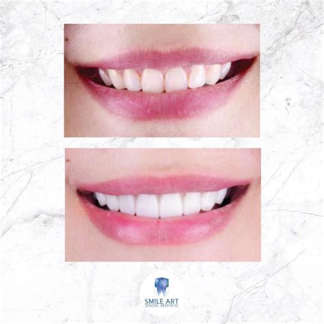 Instant Veneer - Smile Art Dental Aesthetic