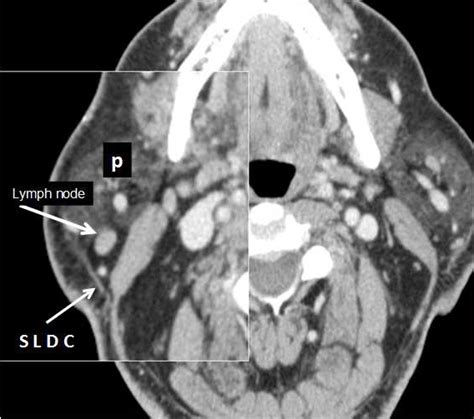 Right subfascial extraglandular parotid lymph node (arrow), noted deep ...