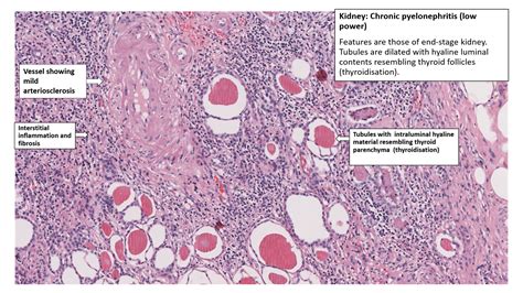 Chronic Pyelonephritis Histology