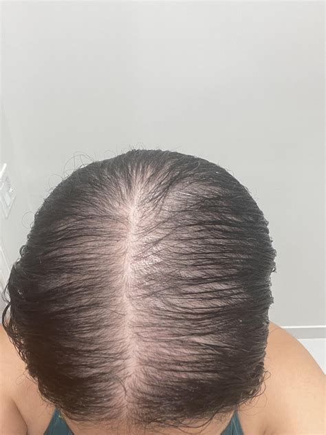 5 month improvement BEFORE AND AFTER : r/FemaleHairLoss