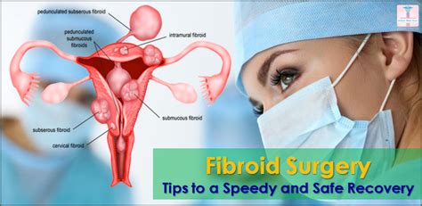 Fibroid Surgery: Tips to a Speedy and Safe Recovery