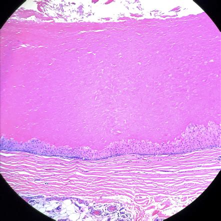 Pilar Cyst Histology