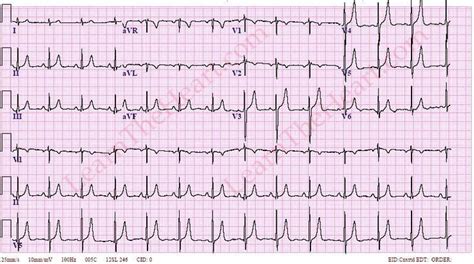 48 best images about Hyperkalemia on Pinterest | Signs, Medical and Blood test