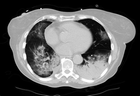 Bronchiolitis Obliterans Organizing Pneumonia/Cryptogenic Organizing Pneumonia