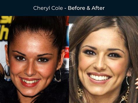 Celebrities With Bad Veneers