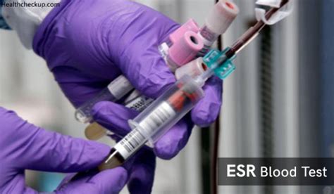 ESR Test Procedure, Normal Ranges and Causes of Low and High ESR