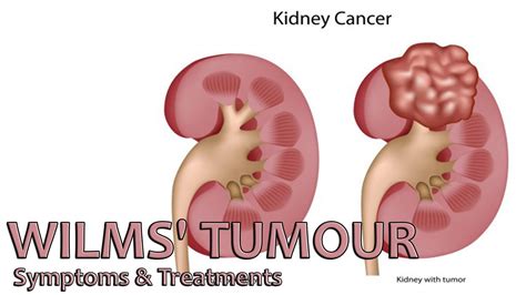 Wilms Tumor Nephroblastoma Symptoms, Prognosis, Treatment, 54% OFF