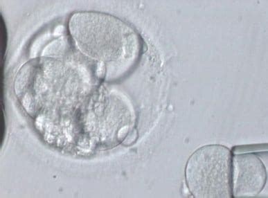 The Embryo Biopsy Procedure - A View Under The Micromanipulator ...