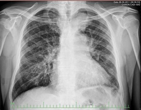 Small cell carcinoma of the lung x ray - wikidoc