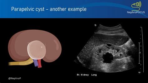 cyst-2 – NephroPOCUS