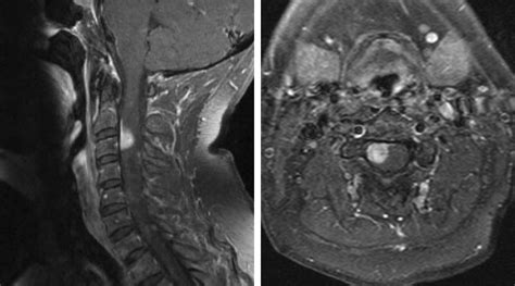 Extramedullary Spinal Cord Tumor | The Neurosurgical Atlas, by Aaron Cohen-Gadol, M.D.