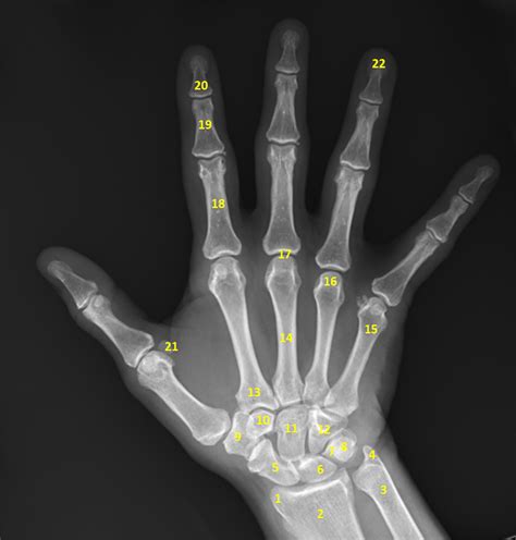 Xray Of Hand Bones