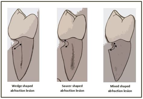 Dental Erosion from Abrasion & Abfraction | Postgraduate Dentistry