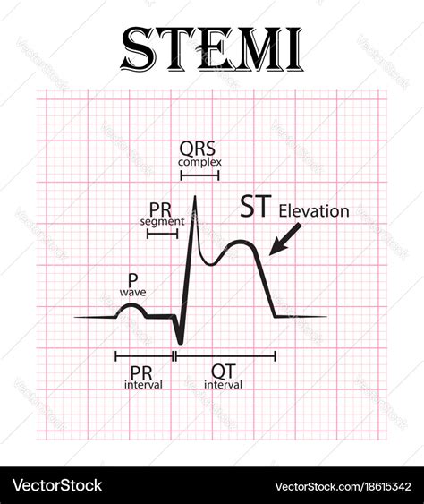 Ecg of st elevation myocardial infarction stemi Vector Image