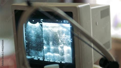 Ultrasound examination of the heart Stock Video | Adobe Stock