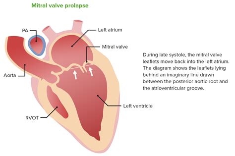 Mitral Valve Prolapse | Concise Medical Knowledge