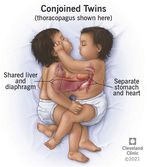 Conjoined Twins: Definition, Causes & Outlook