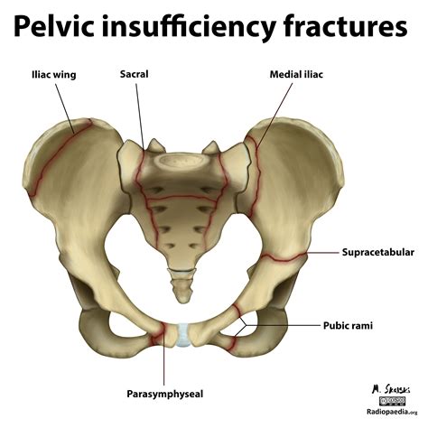 Fotos - Fractures Of The Pelvis