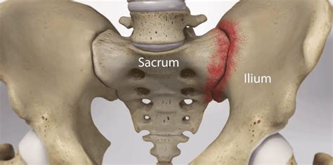 Sacrum Ilium - Florida Surgery Consultants