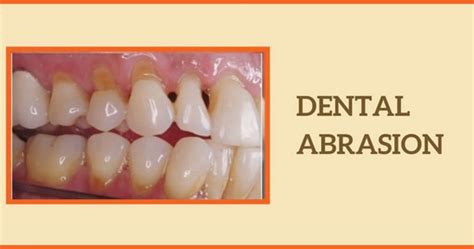 Dental Abrasion: Symptoms, Causes, Treatments