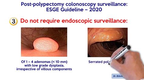 POST-POLYPECTOMY COLONOSCOPY SURVELLAINCE: ESGE GUIDELINES 2020. (Hassan C. et al, Endoscopy ...