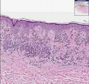 Compound Nevus Histology