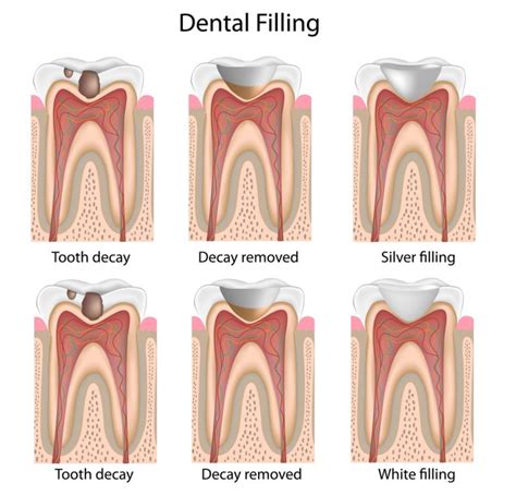 Filling and Tooth Restoration – Shraddhadeep Dental Clinic