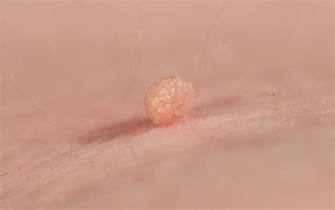 Facts About Skin Tags | University of Utah Health