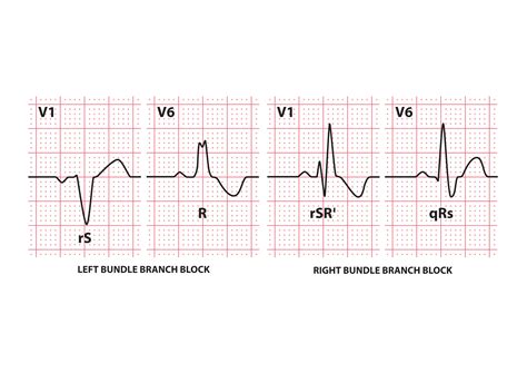 Ecg Bundle Branch Block Medical Mnemonics Sexiz Pix | The Best Porn Website