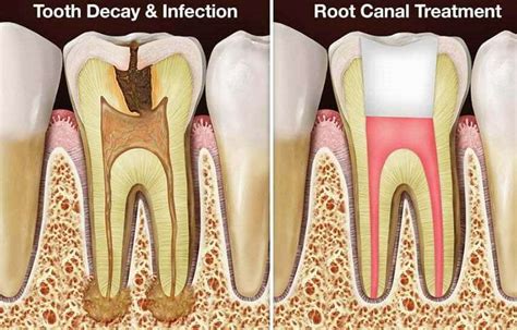 Dental Root Canal Treatment (Endodontic) in Malaysia - Dental Home