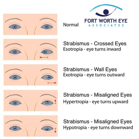 Strabismus Surgery for Misaligned Eyes, Crossed Eyes, or Wall Eyes