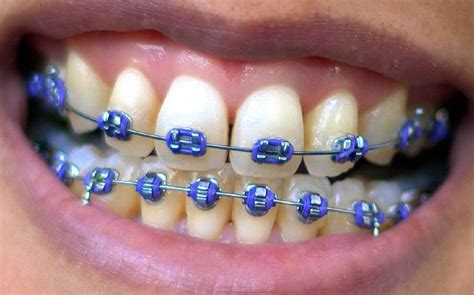 Tooth Trends: Colored Braces