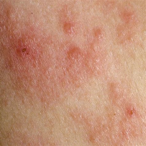 Over the Counter Treatments for Skin Rash | LIVESTRONG.COM